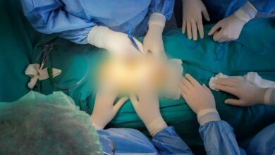 Photo of 811 raste te thyerjes se guarve në veshka në Klinikën e Urologjisë
